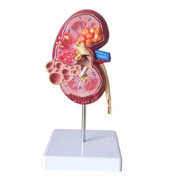 Pažeidimas Inkstų modelis Žmogaus anatomijos organų medicinos mokymo priemonės